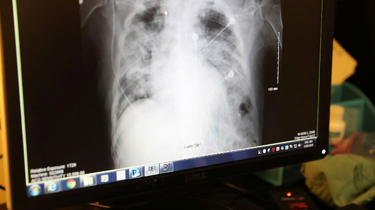 Ist die Lungenfunktion von Covid-19-Patienten so stark eingeschränkt, dass Patienten Sauerstoff über einen Schlauch in der Luftröhre erhalten, können Lungen im Verlauf irreparabel geschädigt werden.