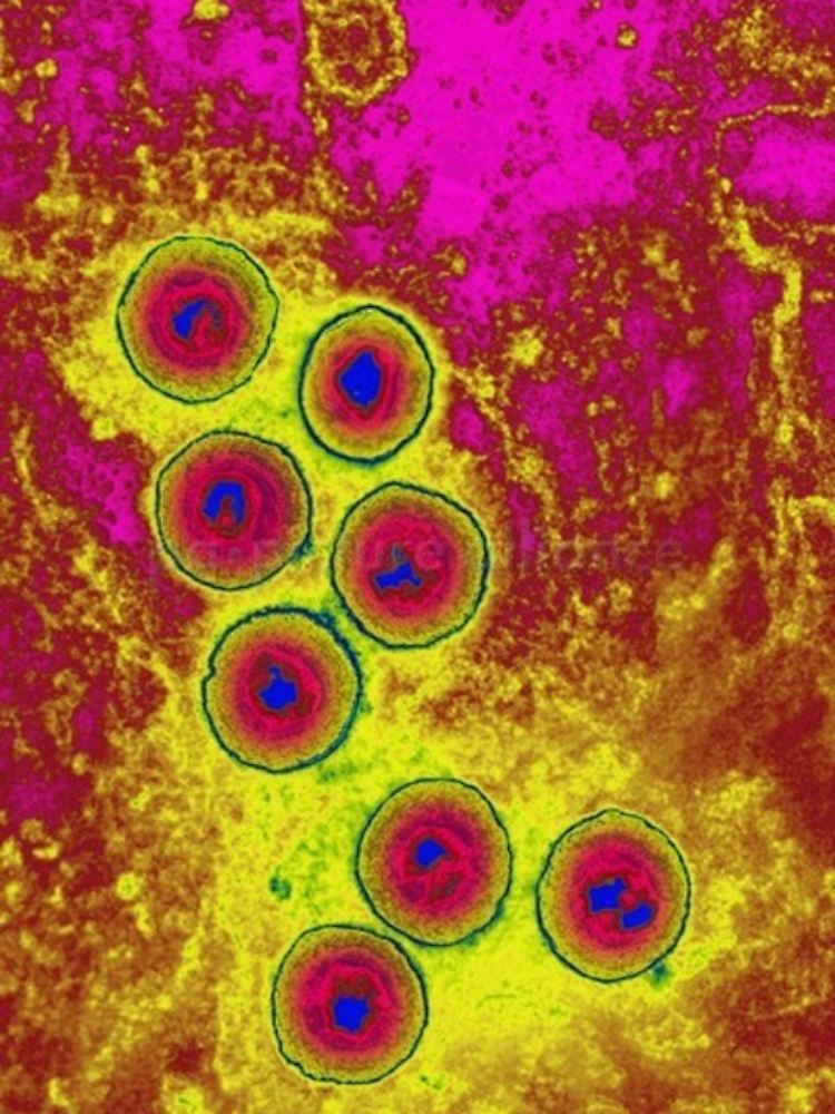 Herpesvirus-Aufnahme mithilfe der Transmissionselektronen-Mikroskopie. Virendurchmesser: um 200 Nanometer (nm).