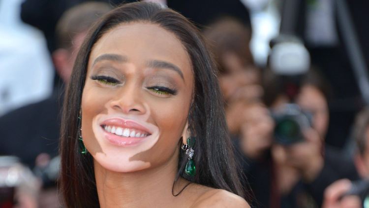 Winnie Harlow sorgte als erfolgreiches Model für mehr Akzeptanz der Autoimmunerkrankung.