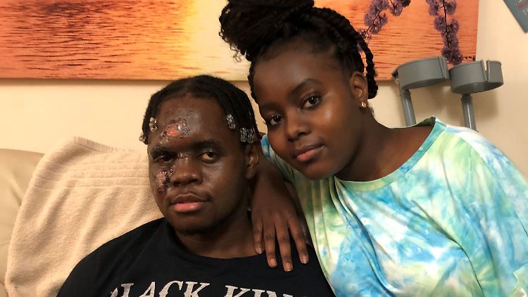 Nach Einschätzung der Ärzte wird es mehr als ein halbes Jahr dauern, bis der 21-Jährige gesund ist.