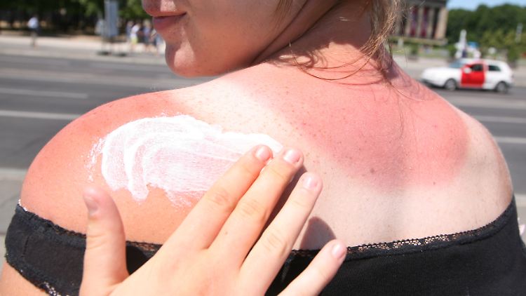 Ein Sonnenbrand ist immer eine Entzündung der Haut und kann bleibenden Schäden hinterlassen.