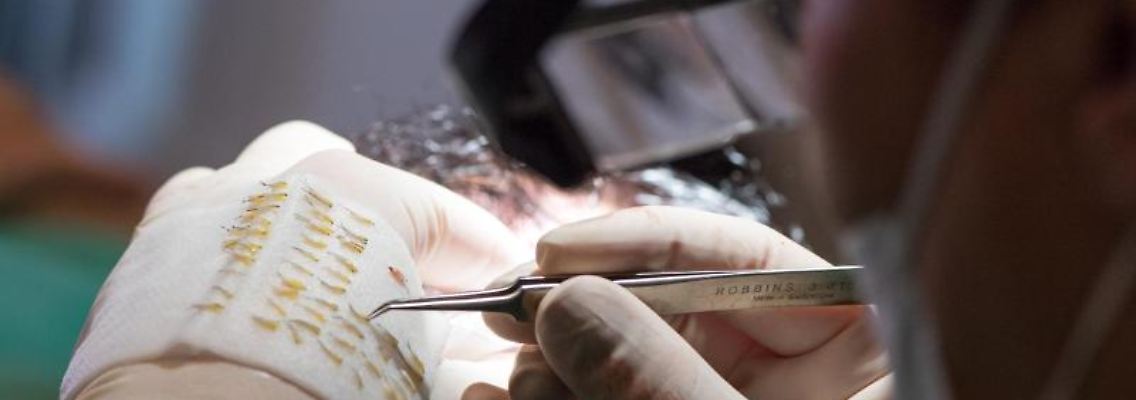 Eine Haartransplantation wird durchgeführt. Foto: Andrea Warnecke/dpa-tmn/Symbolbild