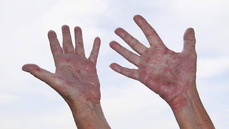 Neurodermitis kann an allen Körperstellen auch noch im Erwachsenenalter entstehen 