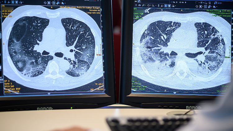 Computertomographieaufnahmen der Lunge eines Covid-19-Patienten: Die linke wurde zu Beginn der Behandlung der Corona-Infektion angefertigt, die rechte 13 Tage später. Die Ausbreitung der weißen Bereiche rechts zeigen eine stärke Infektion mit Wassereinlagerungen in der Lunge. Dadurch ist eine künstliche Beatmung notwendig.