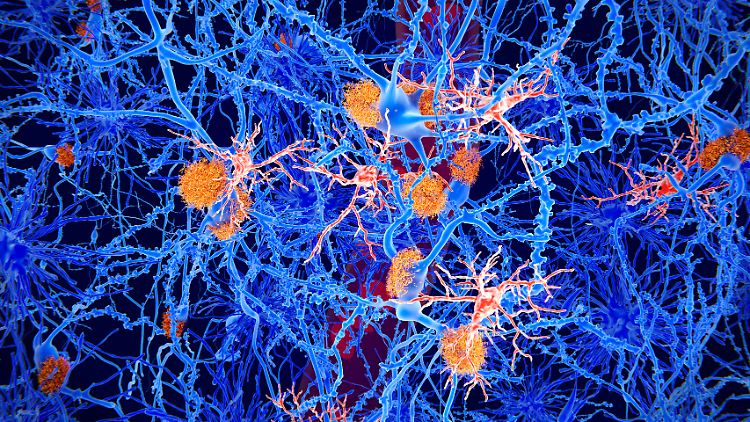 Die für Alzheimer typischen Eiweiß-Ablagerungen im Gehirn: Forscher suchen danach, bevor Symptome auftreten. 