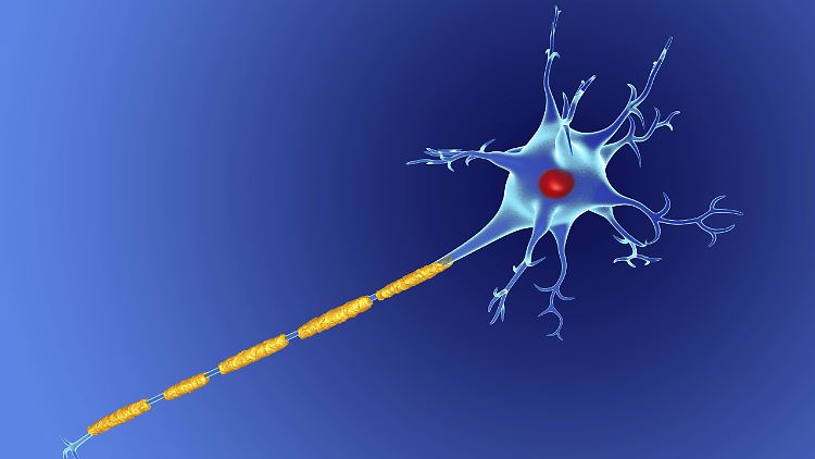 Illustration einer Nervenzelle mit einer beschädigten Myelinscheide (gelb) um ihr Axon: Autoimmunerkrankungen wie MS beruhen auf entzündlichen Prozessen gegen Myelin-Bestandteile.