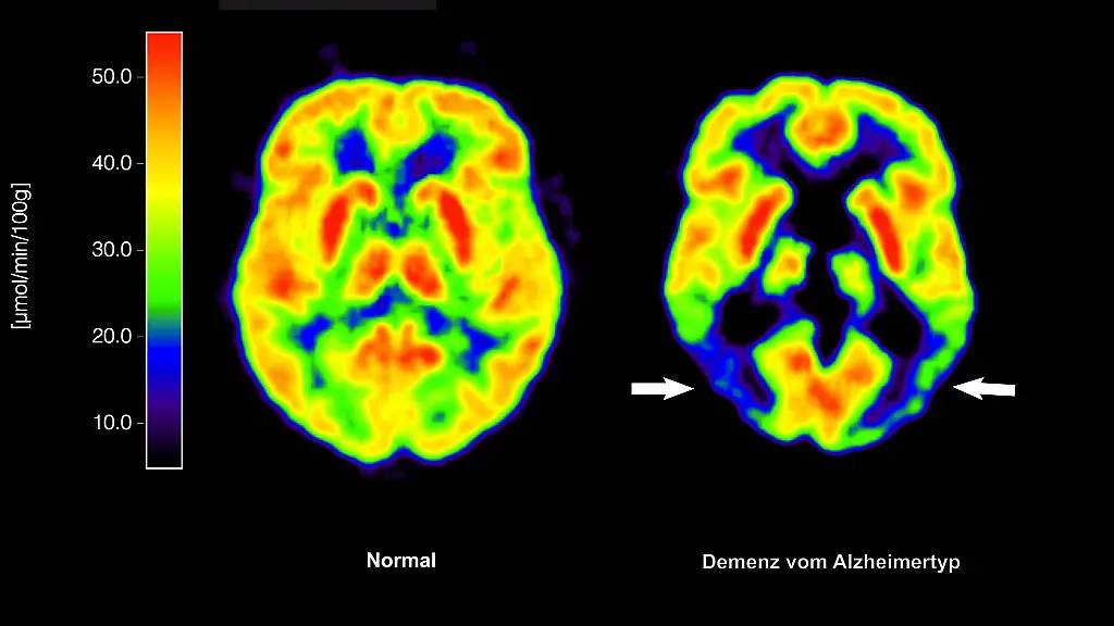 Entscheidung-ueber-die-Zulassung-fuer-Medikament-zur-Behandlung-von-Alzheimer-Patienten-verzoegert-sich