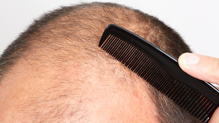 Dass man sich Friseurkosten spart, ist wohl ein schwacher Trost für alle, die unter Haarausfall leiden.