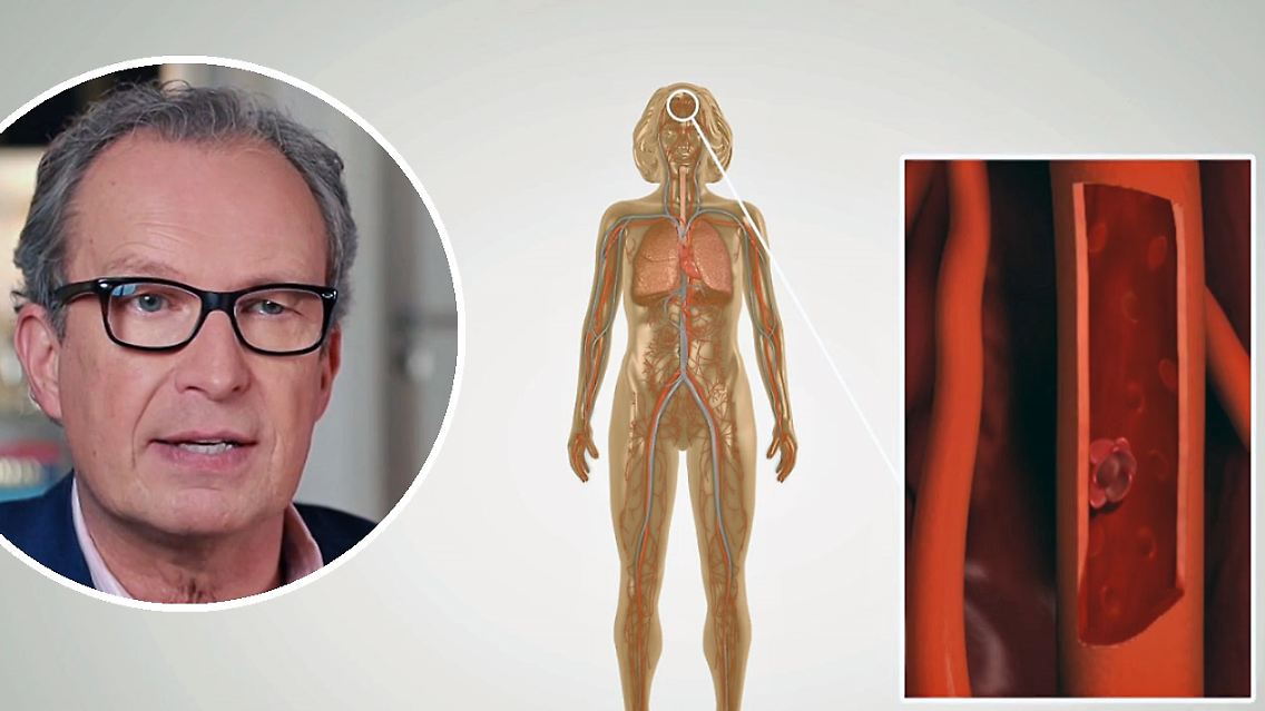 HirnvenenthromboseSpecht.jpg