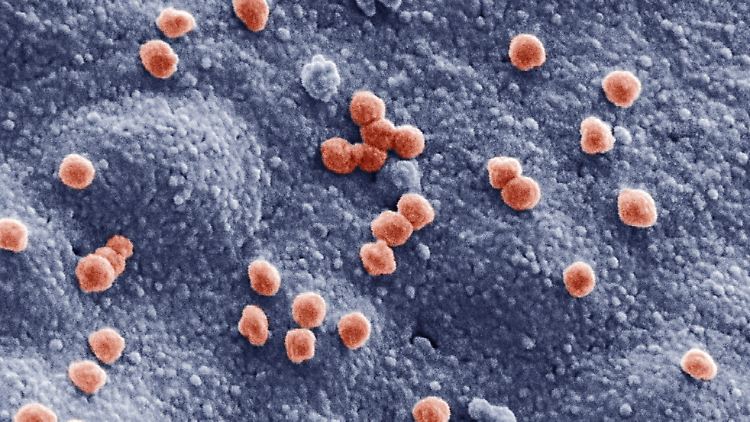 Sars-CoV-2 (Ø 83 nm) auf der Oberfläche einer im Laborexperiment untersuchten Lungenzelle (nachkolorierte, elektronenmikroskopische Aufnahme)