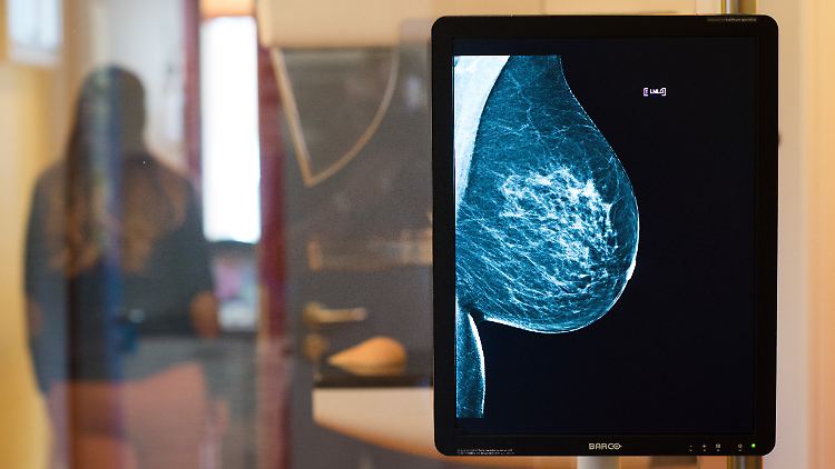 Die gesunde Brust einer Frau auf einem Röntgenbild, bei einem Mammografie-Screening aufgenommen. 