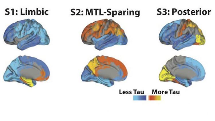Vier Subtypen: Die Bilder zeigen, wie unterschiedlich Tau-Proteine im Gehirn von Alzheimer-Patienten verteilt sein können. 