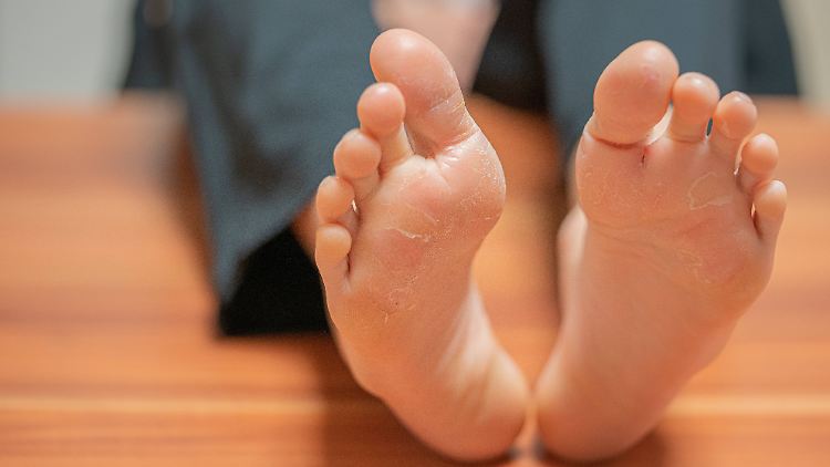 Bei Fuß- oder Nagelpilz sollte man frühzeitig handeln.