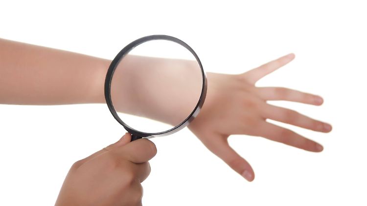Nur geübte Augen können die Vorstufen von Hellem Hautkrebs erkennen.