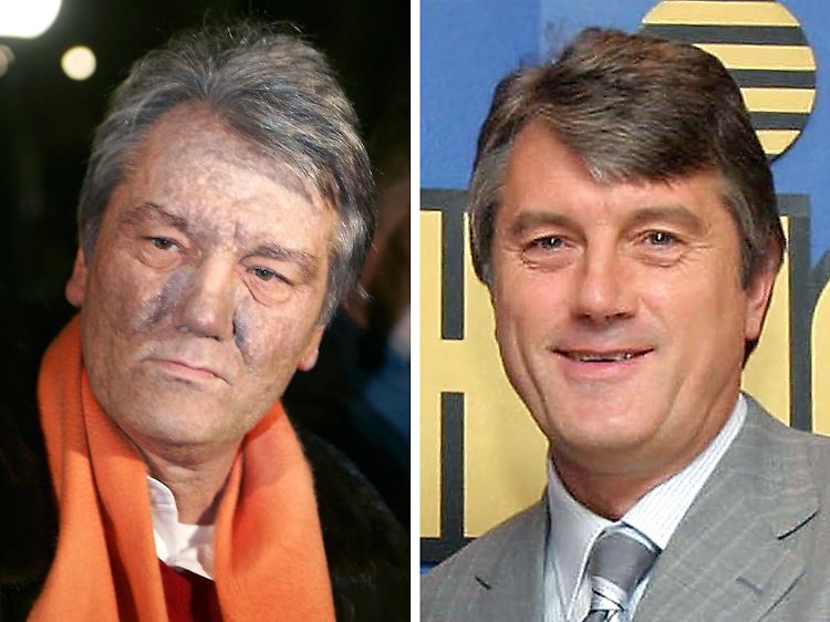 Das Bild zeigt Wiktor Juschtschenko vor (r) und nach der Vergiftung mit TCDD.