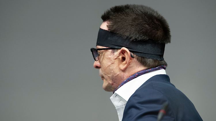 Die Täter lauerten Bernhard Günther vor seiner Haustür auf und übergossen ihn mit hoch konzentrierter Säure.