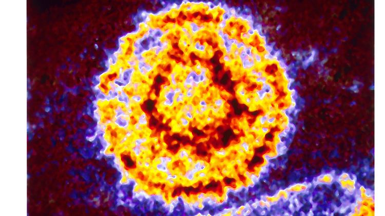 Mehr als 90 Prozent der Menschen infizieren sich im Laufe des Lebens mit dem Epstein-Barr-Virus. 