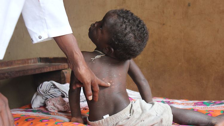 Ein kleines Mädchen wird auf Madagaskar auf Lepra untersucht.