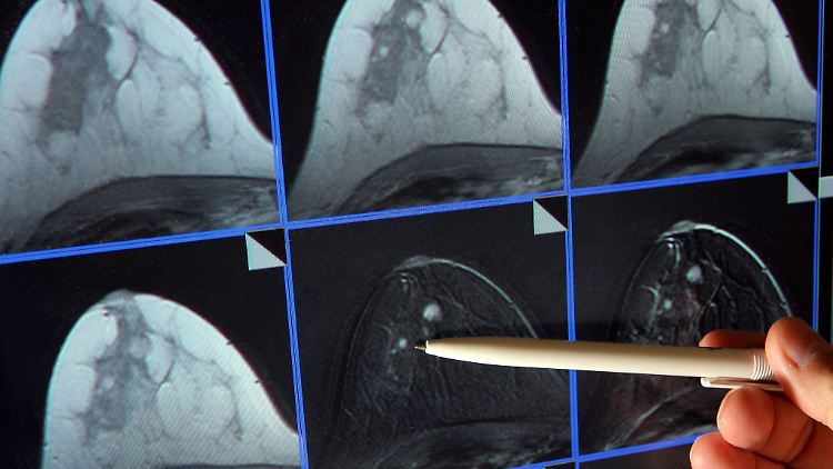 In der Mammographie ist ein winziger Tumor in der Brust einer Frau zu sehen. Oft entscheiden Wochen darüber, ob die Patientin geheilt werden kann.