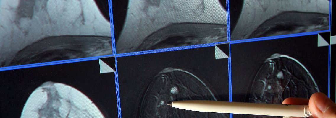 In der Mammographie ist ein winziger Tumor in der Brust einer Patientin zu sehen.