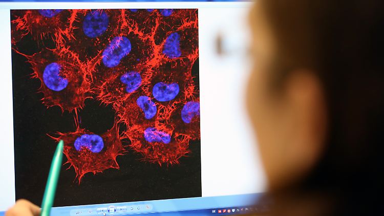 Auf dem Monitor sind vergrößerte Melanom-Zellen, also Zellen des Schwarzen Hautkrebses, zu sehen.