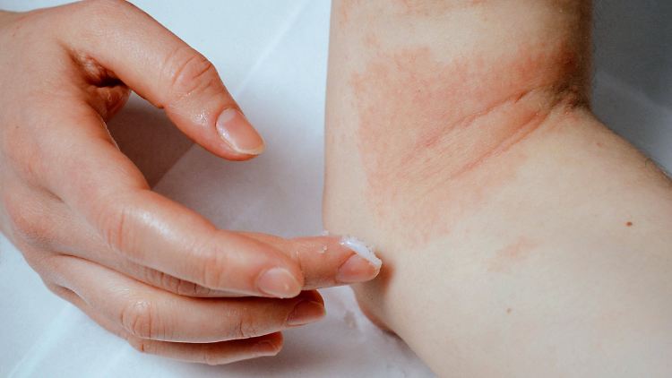 Bei stärkeren Entzündungen der Haut oder dem Verdacht auf Neurodermitis empfehlen die Tester dringend einen Arzt aufzusuchen. 