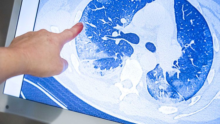 Die Computertomografie zeigt die Lunge eines Covid-19-Patienten. 