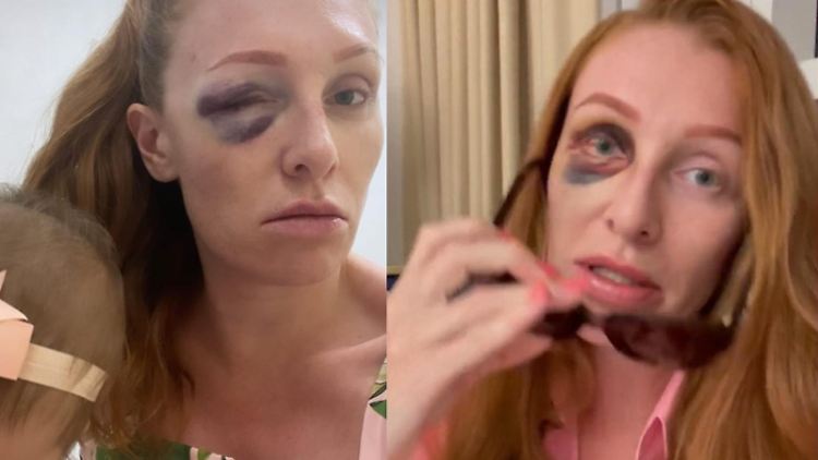 Georgina Fleur nach der brutalen Alkohol-Attacke von "Kubi".