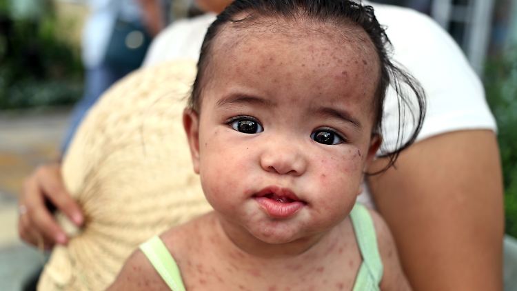 Ein philippinisches Kind, das an Masern leidet: Betroffene haben erst Grippe-Anzeichen, dann einen Hautausschlag.