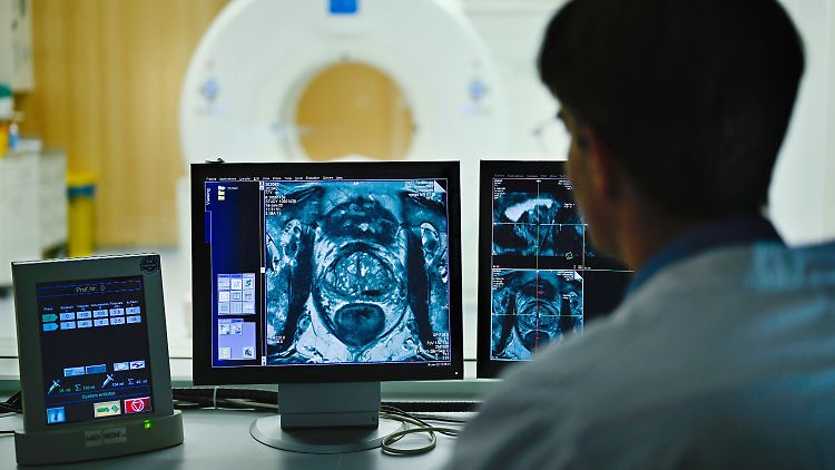 Querschnittsbild einer Prostata. Wird ein bösartiger Tumor in der Prostata früh entdeckt, erhöht das die Heilungschancen deutlich.