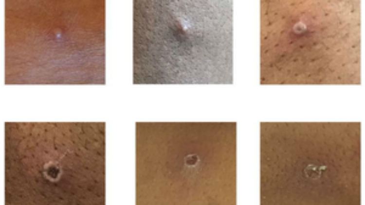 Die von der britischen Gesundheitsbehörde UKHSA zur Verfügung gestellten Bilder zeigen die charakteristischen Pocken.