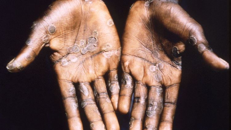 Die Hände eines mit dem Affenpockenvirus infizierten Patienten, aufgenommen 1997 in der Republik Kongo.