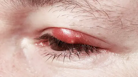 Von Entzndung bis Krebsrisiko: Knstliche Wimpern knnen dem Auge massiv  schaden - ntv.de