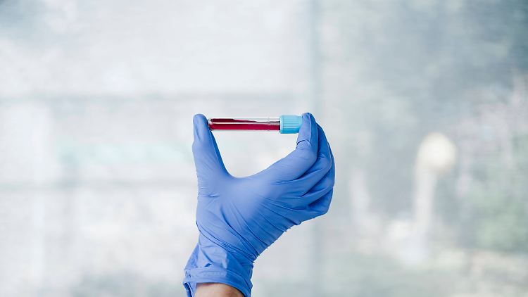 Ein Bluttest soll Parkinson vor Symptombeginn erkennen.