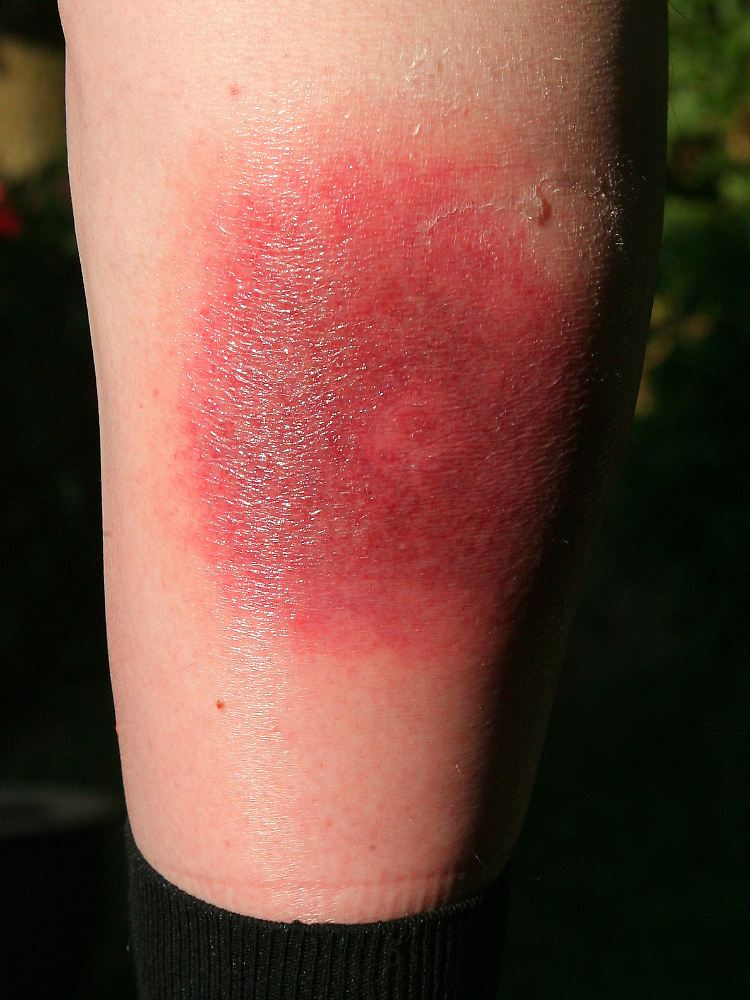 Klares Warnzeichen für Borreliose: Die sogenannte Wanderröte kann Tage oder Wochen nach einem Zeckenstich auftreten.