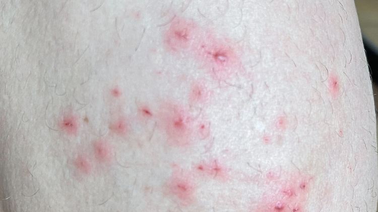 Die typischen Pusteln waren bei vielen Betroffenen erst später aufgetreten.