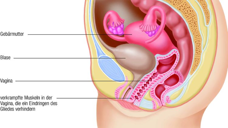 Von Vaginismus Betroffene erleben Schmerzen beim Einführen oder eine unwillkürliche Verkrampfung der Beckenbodenmuskulatur, die die Vagina umgibt.