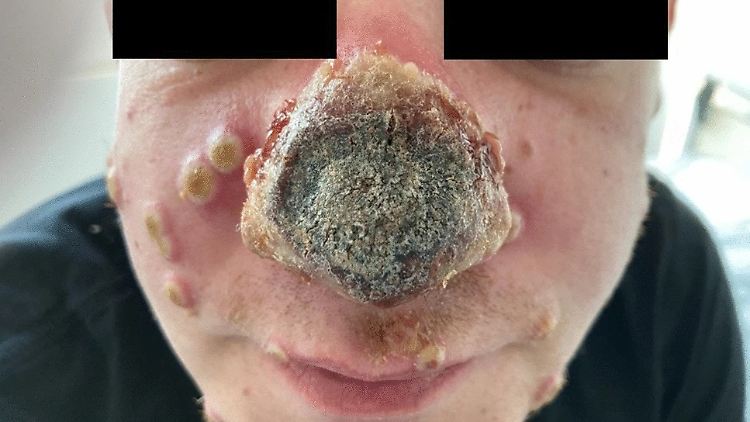 Das Immunsystem des Mannes war durch die Mehrfachbelastung geschwächt.