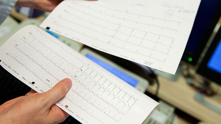 Vorhofflimmern: Vergleich eines unauffälligen EKGs (oben) mit einem auffälligen.
