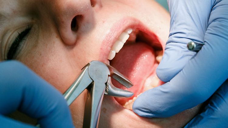 Im Durchschnitt zog der Angeklagte jedem Patienten elf Zähne, heißt es in einem Expertenbericht. (Symbolfoto)