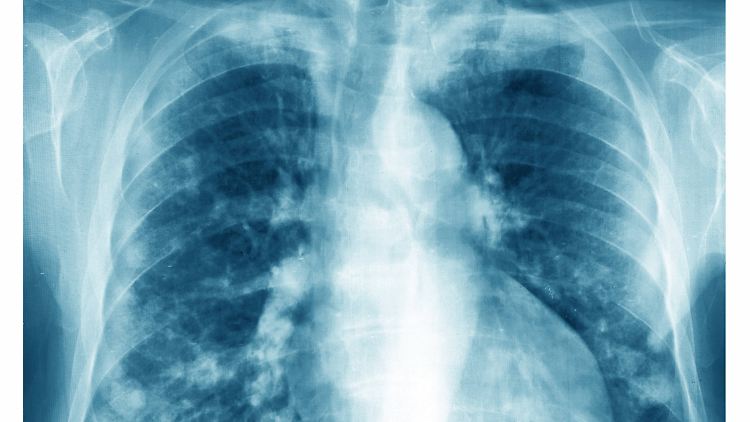 Auch bei Gesunden gibt es Gen-Mutationen in Lungenzellen. Erst Feinstaub kann dies zum Problem werden lassen.