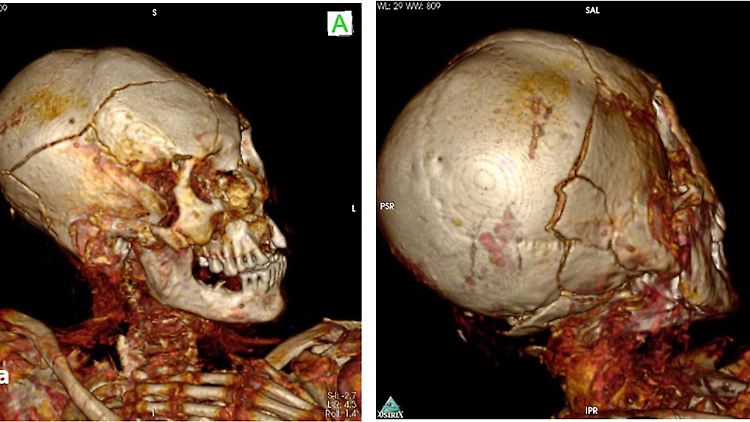 3D-CT-Scan des Schädels der männlichen Mumie aus Délémont.