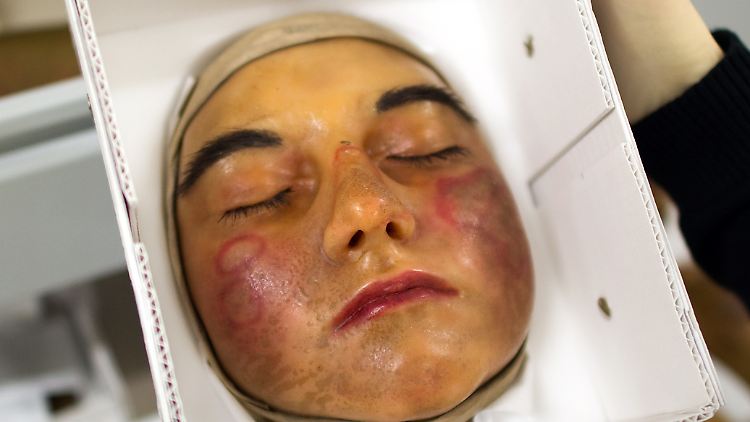 Die Wachsmoulage im Deutschen Hygiene-Museum in Dresden zeigt ein junges Mädchen mit Lupus erythematodes an Nase und Wange.