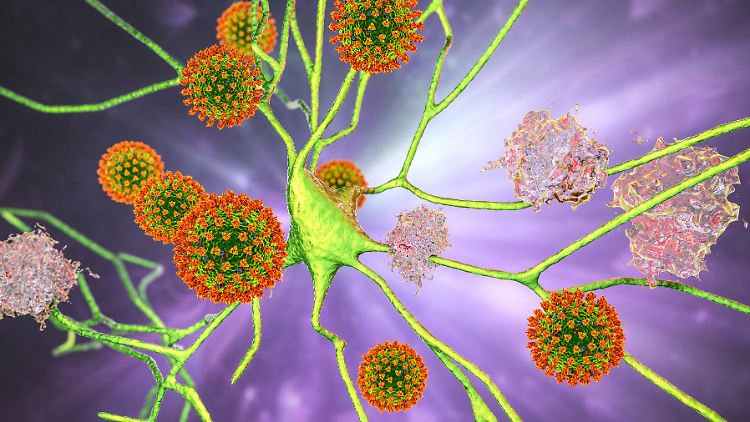 Die Grafik zeigt, wie Sars-CoV-2  und sogenannte Amyloid-Plaques Nerrvenzellen im Gehirn befallen könnten. 
