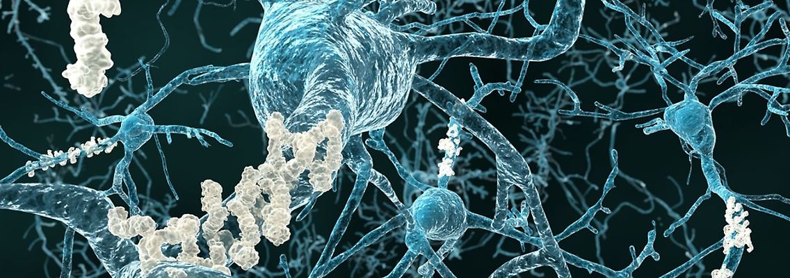 Eiweißablagerungen zwischen den Nervenzellen (Plaques) sind zum Teil ursächlich für Alzheimer-Symptome.