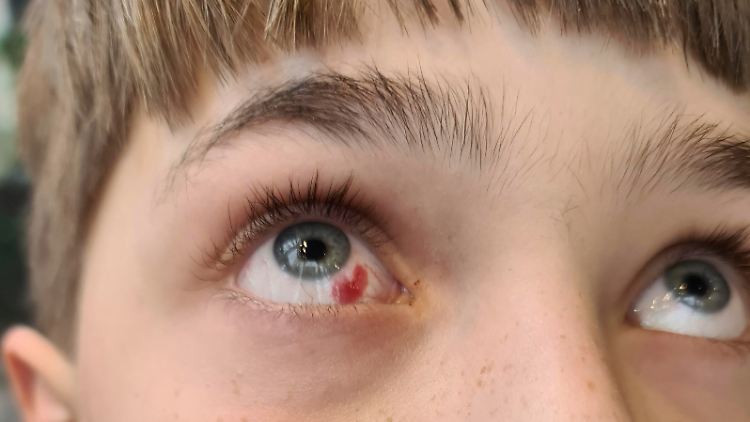 Das Auge ist von feinen Blutgefäßen durchzogen. Dass da mal eines platzt und für ein rotes Auge sorgt, lässt sich kaum vermeiden. Bei einer Verletzung sollte man aber am besten in eine Augenarztpraxis.