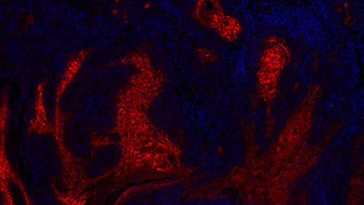 Plattenepithelkarzinom der Haut, das den Botenstoff Angiopoietin-like 4 (ANGPLT4) ausstößt. Mit fortschreitendem Tumorwachstum ist mehr ANGPTL4 im Gewebe vorhanden, fanden die Forscher heraus.