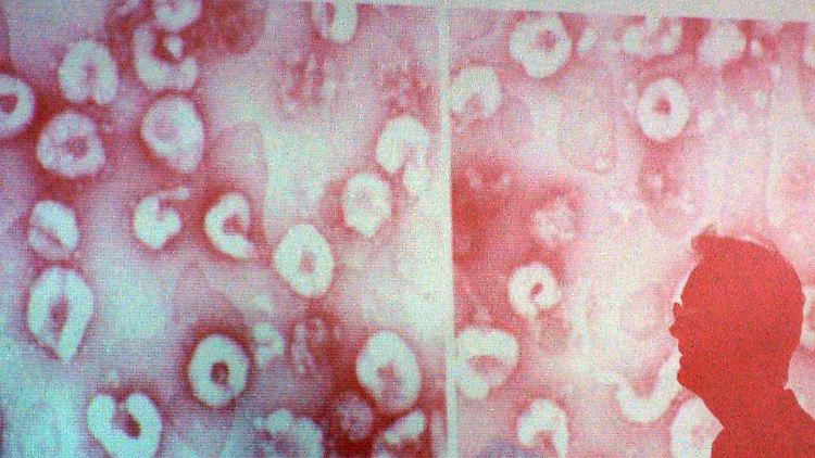 Der Chefarzt der Lungenklinik Hemer in NRW steht im Frühjahr 2003 vor einer Projektion, die das neuartige Coronavirus zeigt. Die Lungenseuche SARS hatte damals bereits Deutschland erreicht.