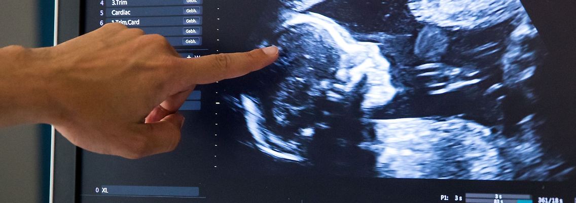 Während einer pränatalen Ultraschall-Untersuchung einer in der 18. Woche schwangeren Frau deutet ein Arzt auf den Kopf des Kindes.