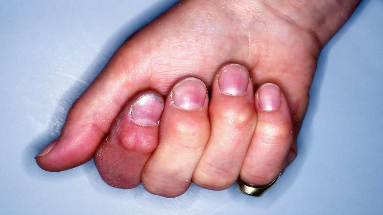 Rheumatoide Arthritis oder primär chronische Polyarthritis der Hand mit Aufreibung und Deformierung der Fingermittel- und Fingerendgelenke.